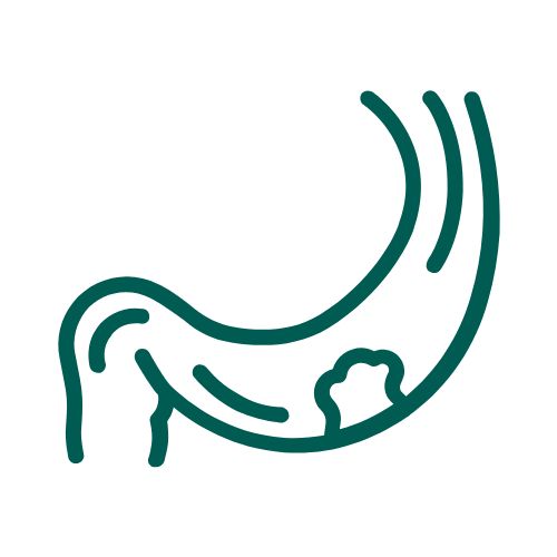 Εκκολπωματίτιδα