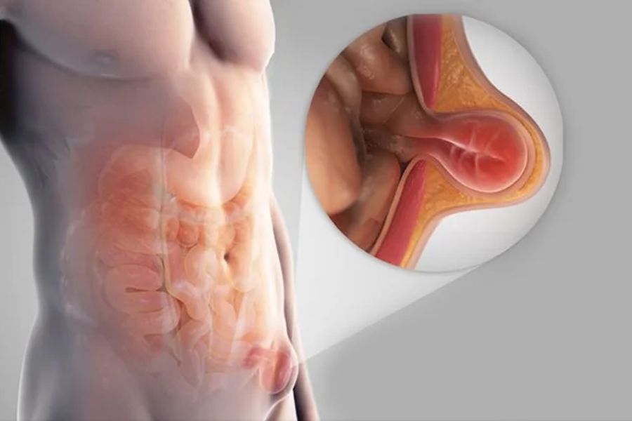 Ρομποτική Χειρουργική Βουβωνοκήλης