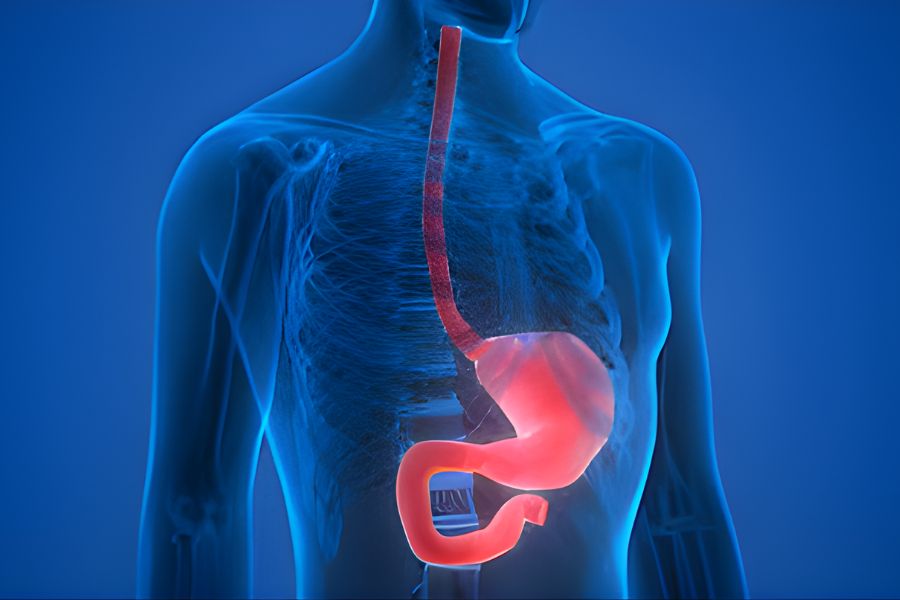 Αχαλασία Οισοφάγου: POEM ή Μυοτομή Heller; Τι λένε τα δεδομένα